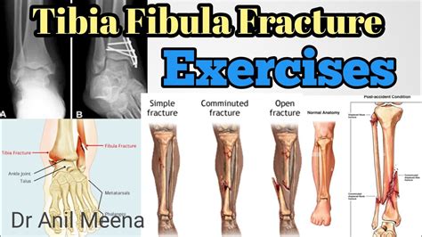 Tibia Fracture Recovery Exercises Tibia Fracture Exercises Ankle