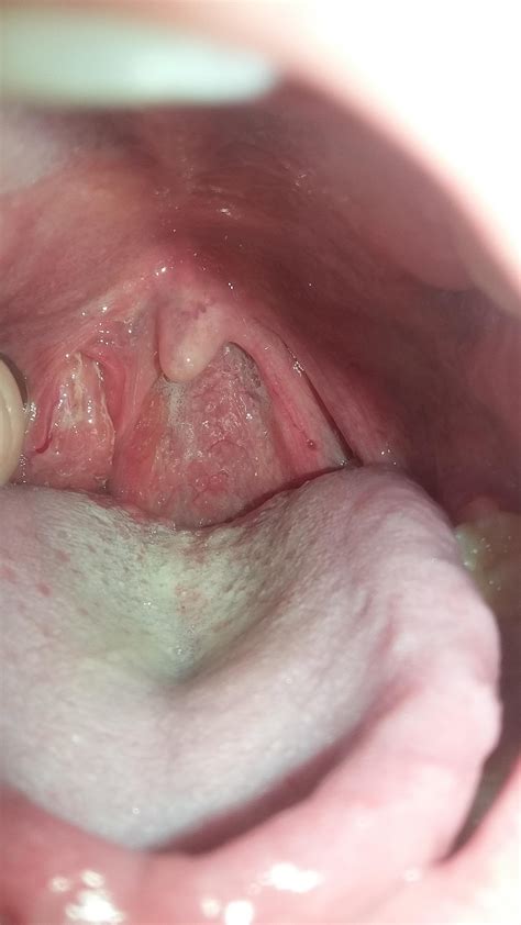 Gross Whats Wrong With My Tonsilsthroat Tonsilstones