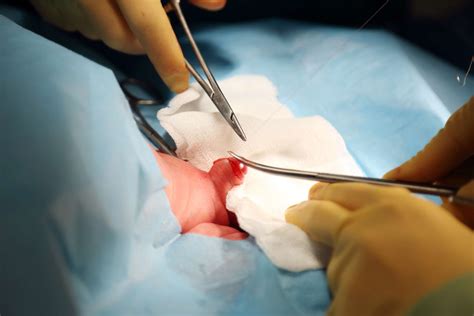 Circuncisión todo lo que necesita saber Medicina Básica