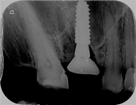 Immediate Implant In Upper Molar Dr Ashish Shah