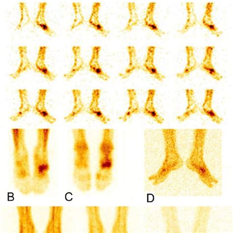 Images Of Three Phase Bone Scintigraphy Of A Patient With Osteomyelitis