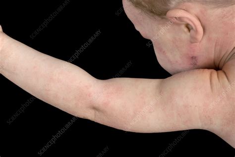 Atopic Eczema On A Babys Arm Stock Image C0389478 Science Photo