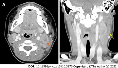 Figure 1 From Lymph Node First Presentation Of Kawasaki Disease In A 12