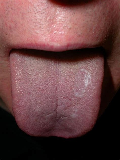 Leukoplakia