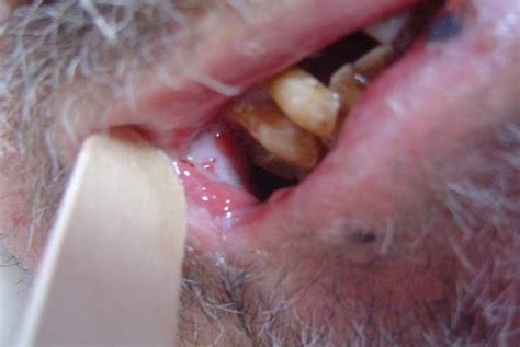 Figure 1 From Early Onset Pancytopenia And Skin Ulcer Following Low