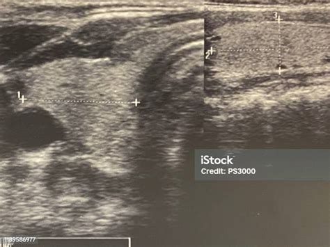 Ultrasound Image Of Normal Human Thyroid Gland Stock Photo Download