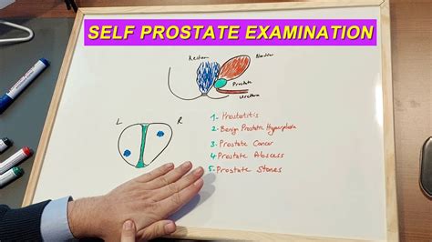 Self Examination Prostate Cancer Bph Or Prostatitis Touch Your Prostate Today Youtube