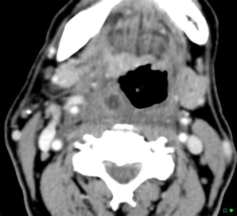 Peritonsillar Abscess Quinsy Radiology Case