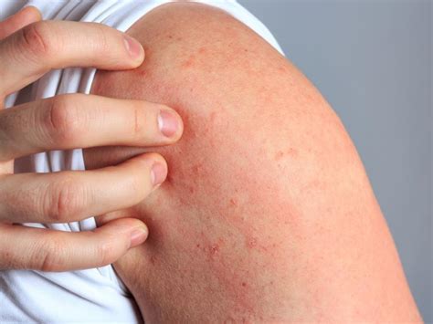 Scabies Rash Treatment Symptoms Bites How To Get Rid