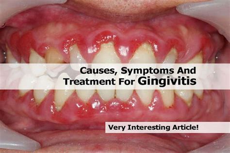 Causes Symptoms And Treatment For Gingivitis