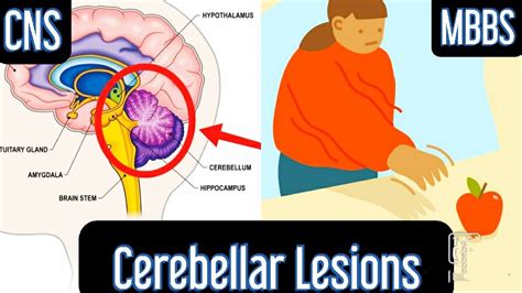 Signs Of Cerebellar Lesions Mbbs Medicine Next Usmle Youtube
