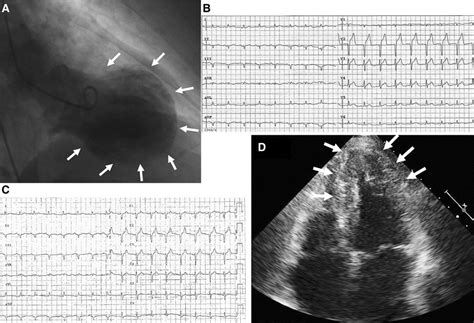 Three Recurrent Episodes Of Apical Ballooning Takotsubo Cardiomyopathy