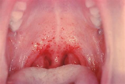 Strep Throat Causes Signs Symptoms Diagnosis Antibiotic Treatment