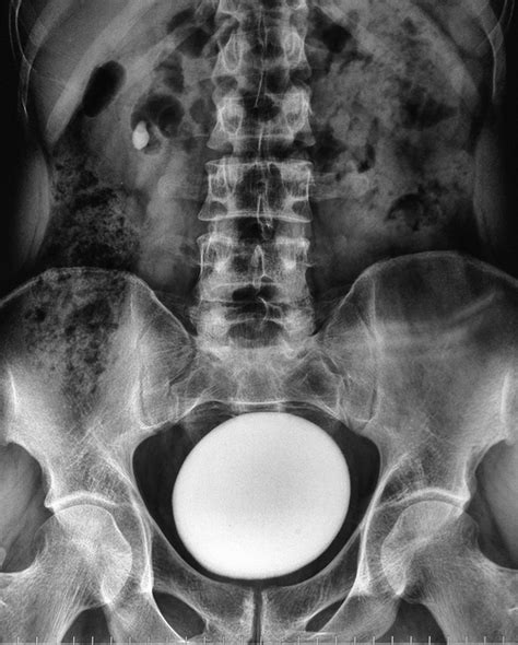 Delivery Of Huge Bladder Stone In A Thirty Five Year Old Man Nephro