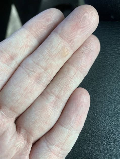 Feeling Miserable With These Blisters On Fingers And Side Of My Hands