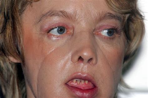 Worlds Most Amazing Miracle Face Transplants After Horrific Life