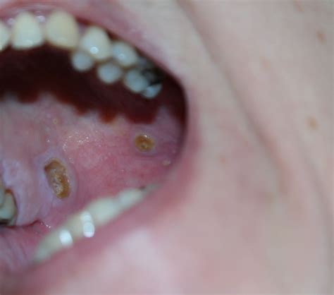 Sores On Roof Of Mouth