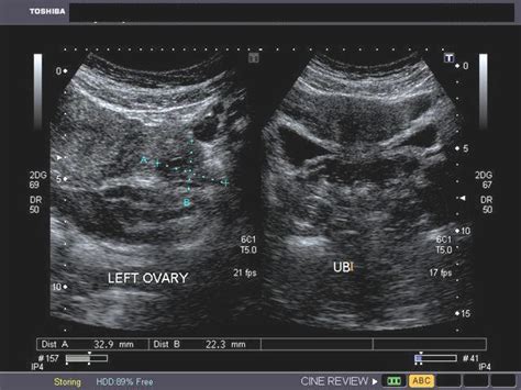 Ovarian Cyst Transabdominal Ultrasound