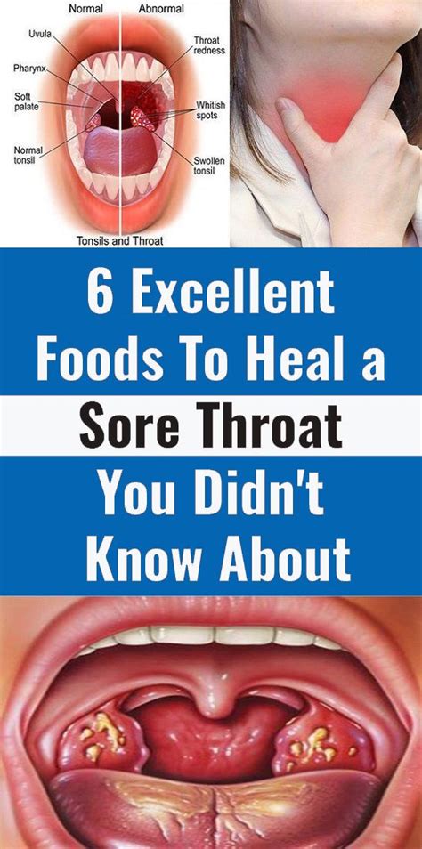 Foods That Can Help You Heal Sore Throat Health And Tips