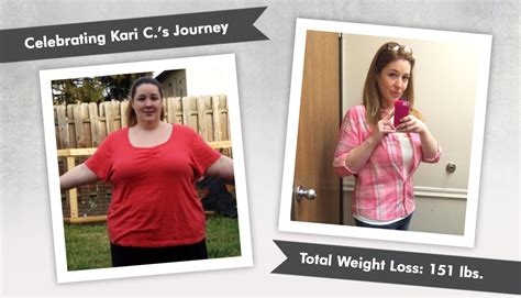Before And After Vsg With Kari C Losing 151 Pounds Obesityhelp
