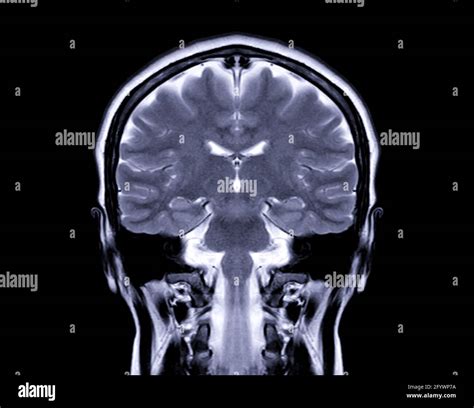 Mri Brain Coronal T2w View For Detect A Variety Of Conditions Of The