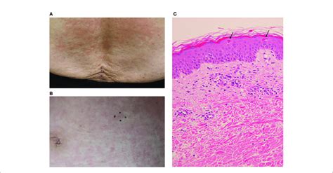 The Patients Skin Rash And Its Pathological Findings A Skin Rash