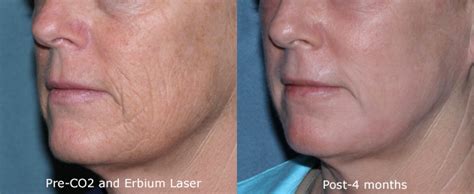 Lasers For Deep Wrinkles By San Diego Dermatologists