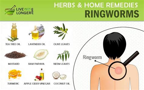 10 Natural Home Remedies For Ringworm Treatment 2021