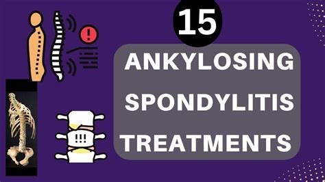 Top 15 Treatments For Ankylosing Spondylitis Youtube