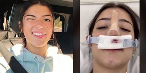 Heres Why Tiktok Star Charli Damelio Had To Get Surgery On Her Nose