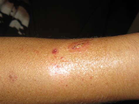 Red Spots On Forearm