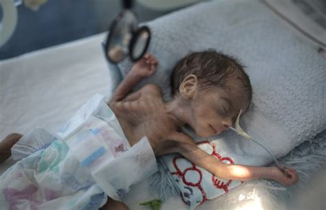 Millions Of Yemeni Children Could Starve Amid Pandemic Unicef Says