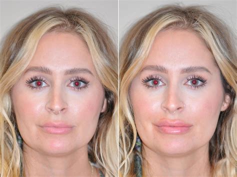 Botox Injections Before And After Photos Plastic Surgery Chevy Images