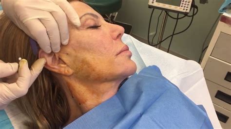 Thread Facelift Procedure With Dr Steven Hopping At The Center For