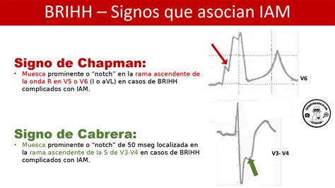 Cardiotruco Signos De Chapman Y Cabrera Cardioprimaria Ferrol
