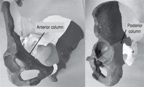 Anterior And Posterior Acetabular Columns Download Scientific Diagram