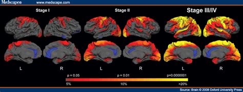 Huntington's Disease by Raegen and Molly