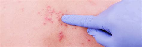 Herpes Zoster Infections
