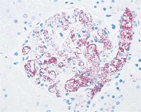Immunohistochemical Stain Of A Kidney Sample Demonstrating Granular