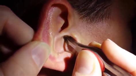 New Omg Top Giant Ear Wax Removal Biggest Ear Wax Removal Extremely Disgusting Youtube