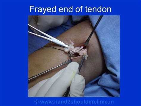Rupture Of Distal End Of Biceps Tendon Hand2shoulder Clinic