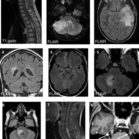 Representative Neurological Mri Of Patients Individual Mri At The