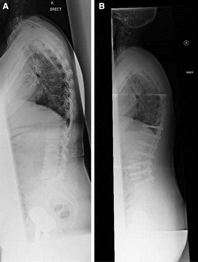 A Preoperative Full Length Standing X Ray Of A 73 Years Old Female