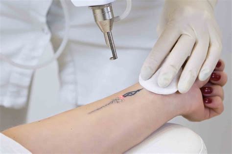 The answer is a definite yes when it comes to the procedure of laser tattoo removal. Reasons Why Laser Tattoo Removal Is The Best - Better Off