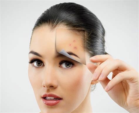 How To Remove Dark Spots Caused By Pimples By Expert Herzindagi