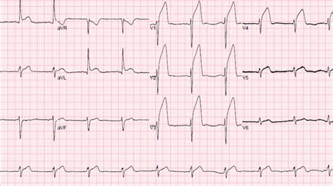 Rott, d., & leibowitz, d. How to deal with thrombus during PCI for STEMI - Part 1
