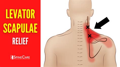 How To Fix Levator Scapulae Pain For Good Spinecare