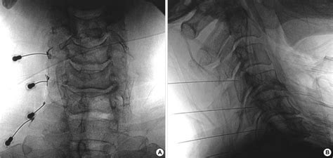 Radiograph Of Cervical Spine Anteroposterior A And Lateral View B