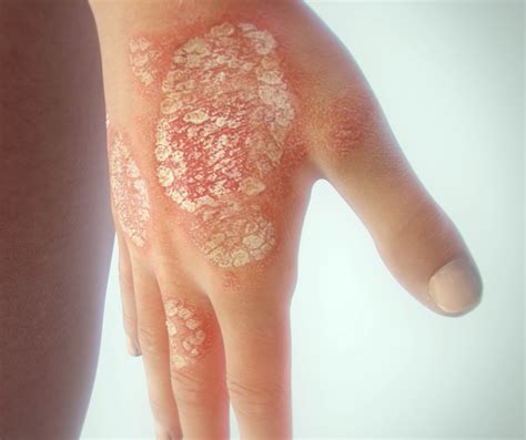 Federal Health Minister Announces Feb 1 Pbs Listing Of Psoriasis