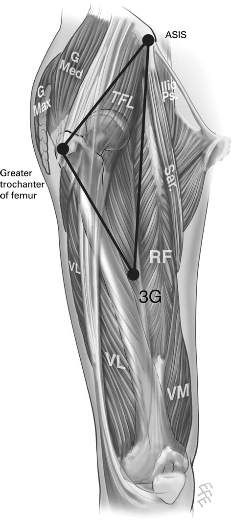 The Greater Trochanter Triangle A Pathoanatomic Approach To The